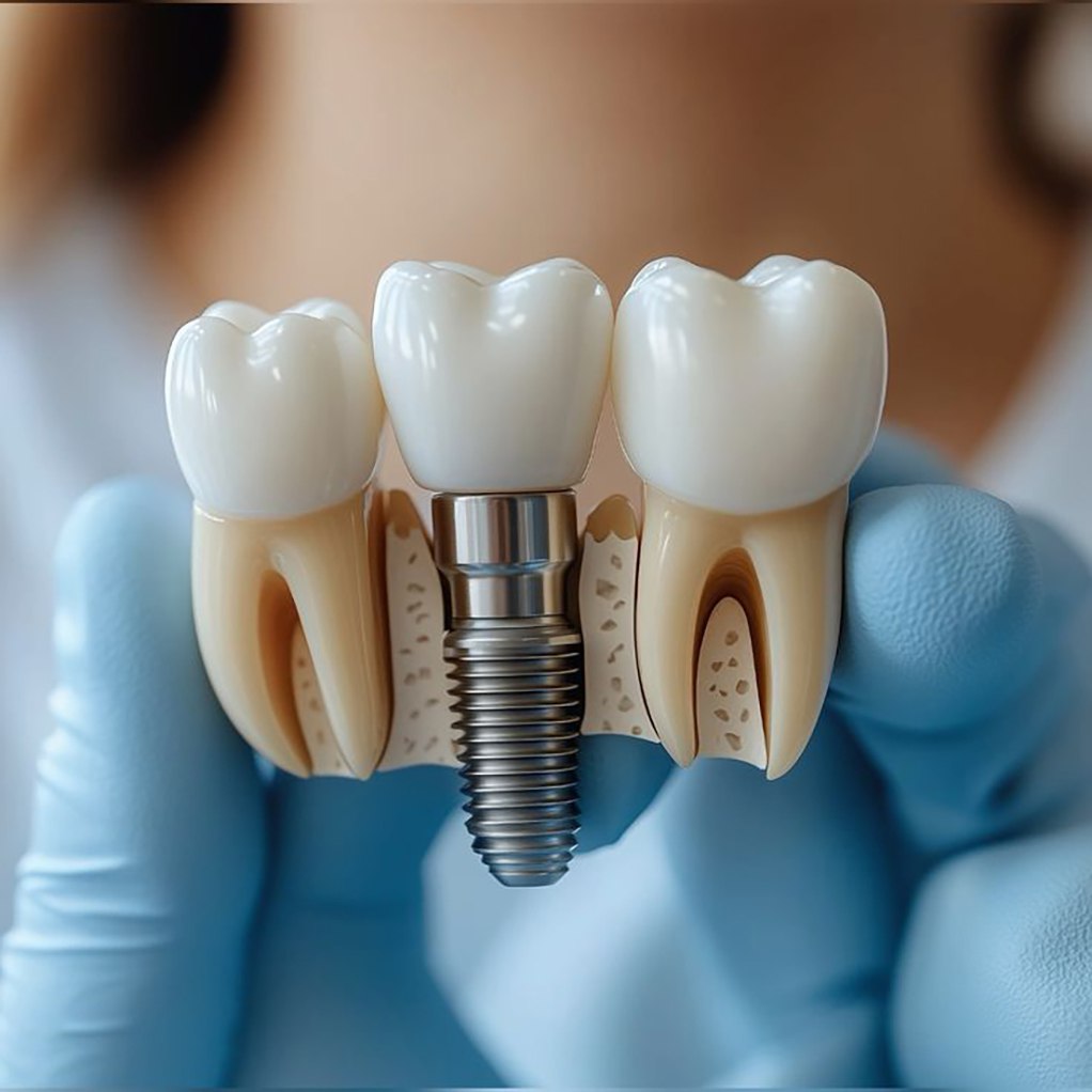 ایمپلنت دیجیتال در مشهد