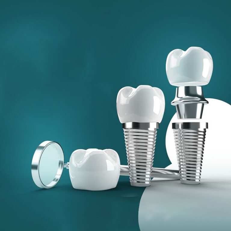 ایمپلنت کره ای مشهد