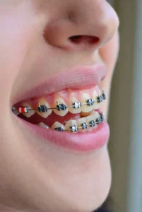 ارتودنسی دندان مشهد