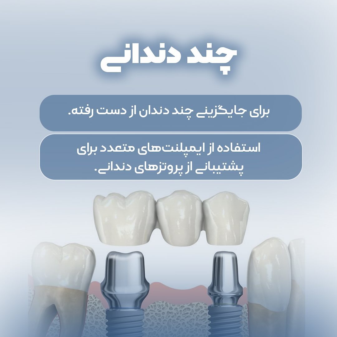 انواع روش های ایمپلنت 2