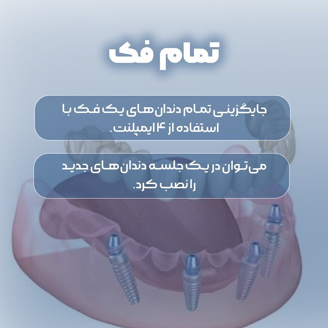 انواع روش های ایمپلنت 3