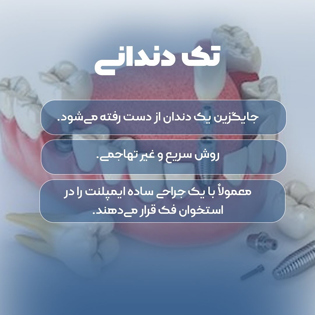 انواع روش های ایمپلنت 4