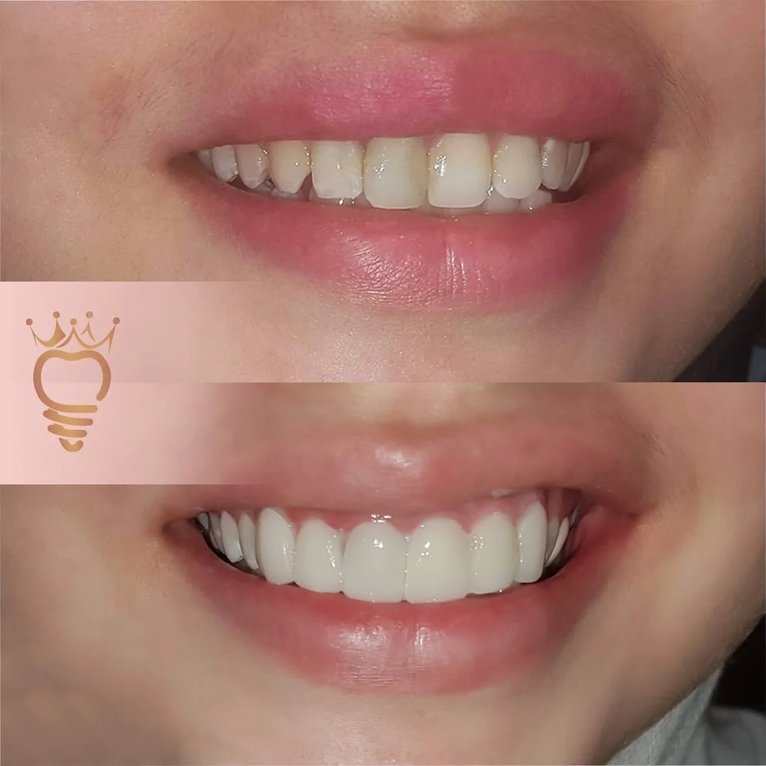 بروساژ دندان