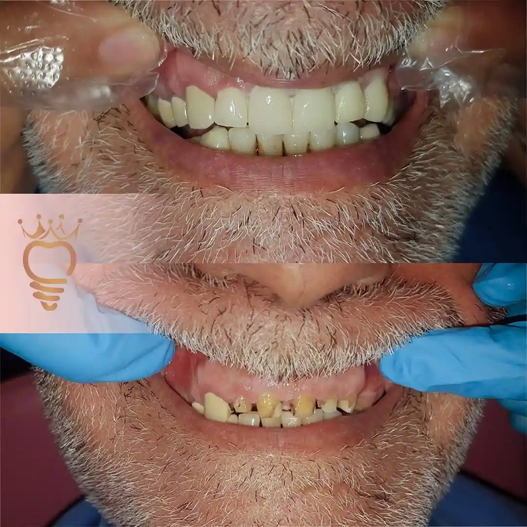 روکش تمام سرامیک زیرکونیوم