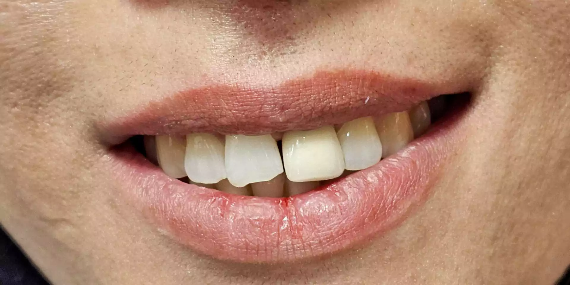 قبل روکش تمام چینی پرسلن شش دندان فک بالا