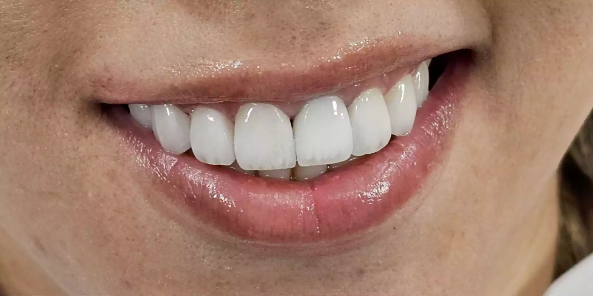 بعد از انجام روکش پرسلن