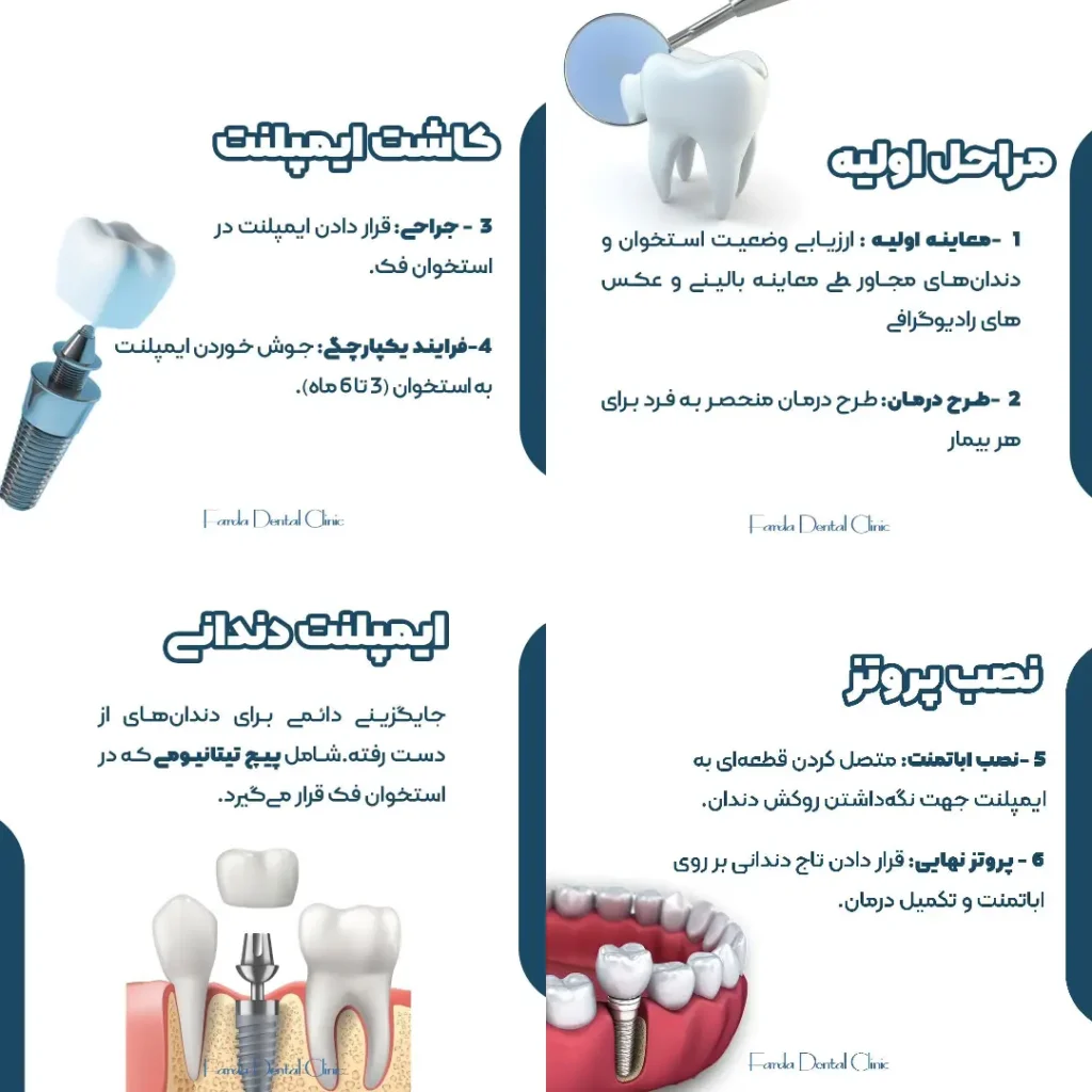 مراحل کاشت ایمپلنت 