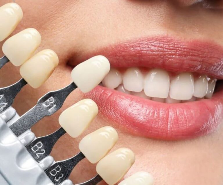 کامپوزیت دندان مشهد