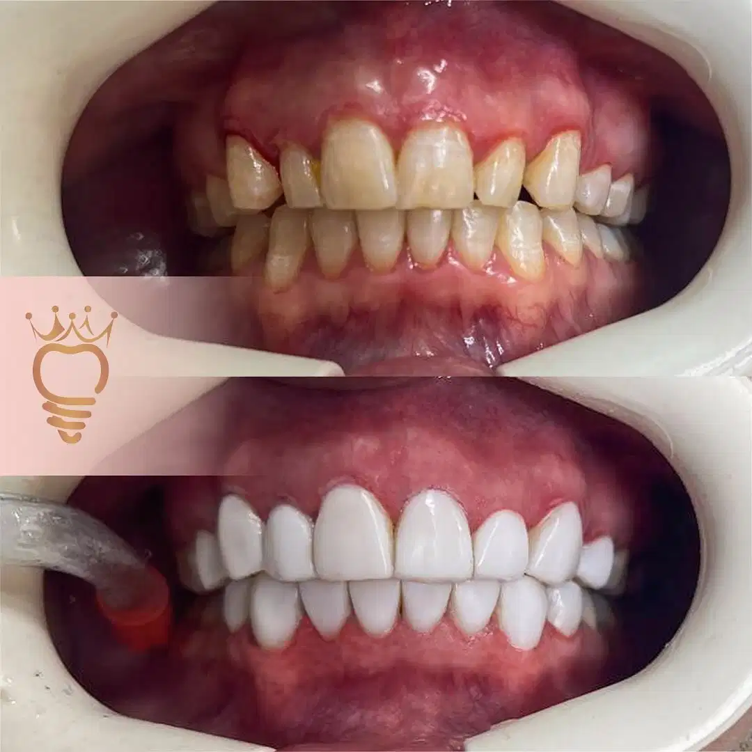 ونیر کامپوزیت دندان در کلینیک فردا