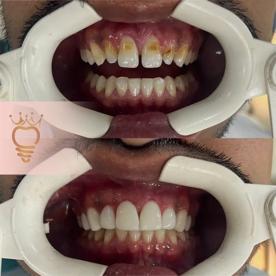 کامپوزیت دندان در کلینیک فردا مشهد