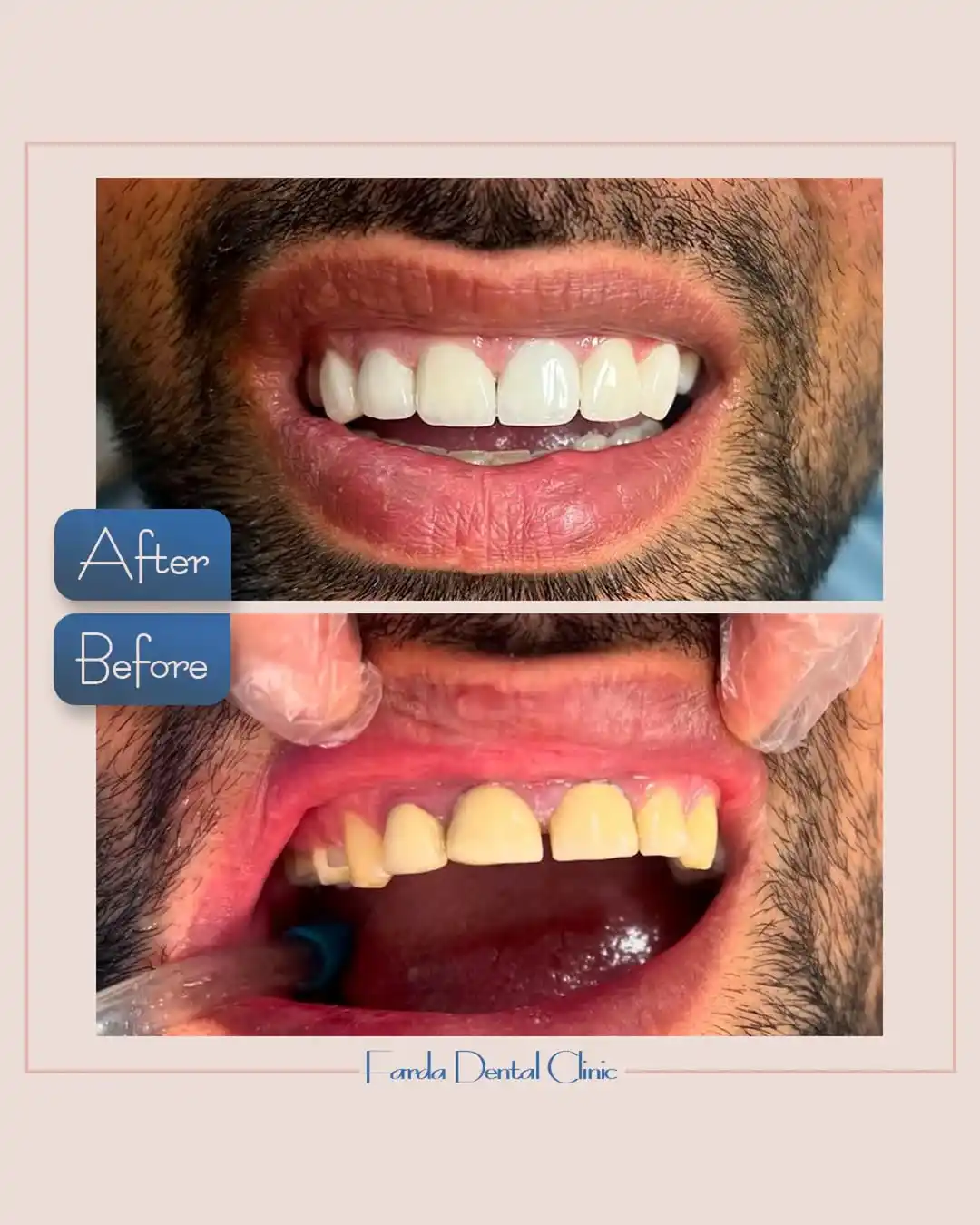 نمونه کامپوزیت دندان مشهد