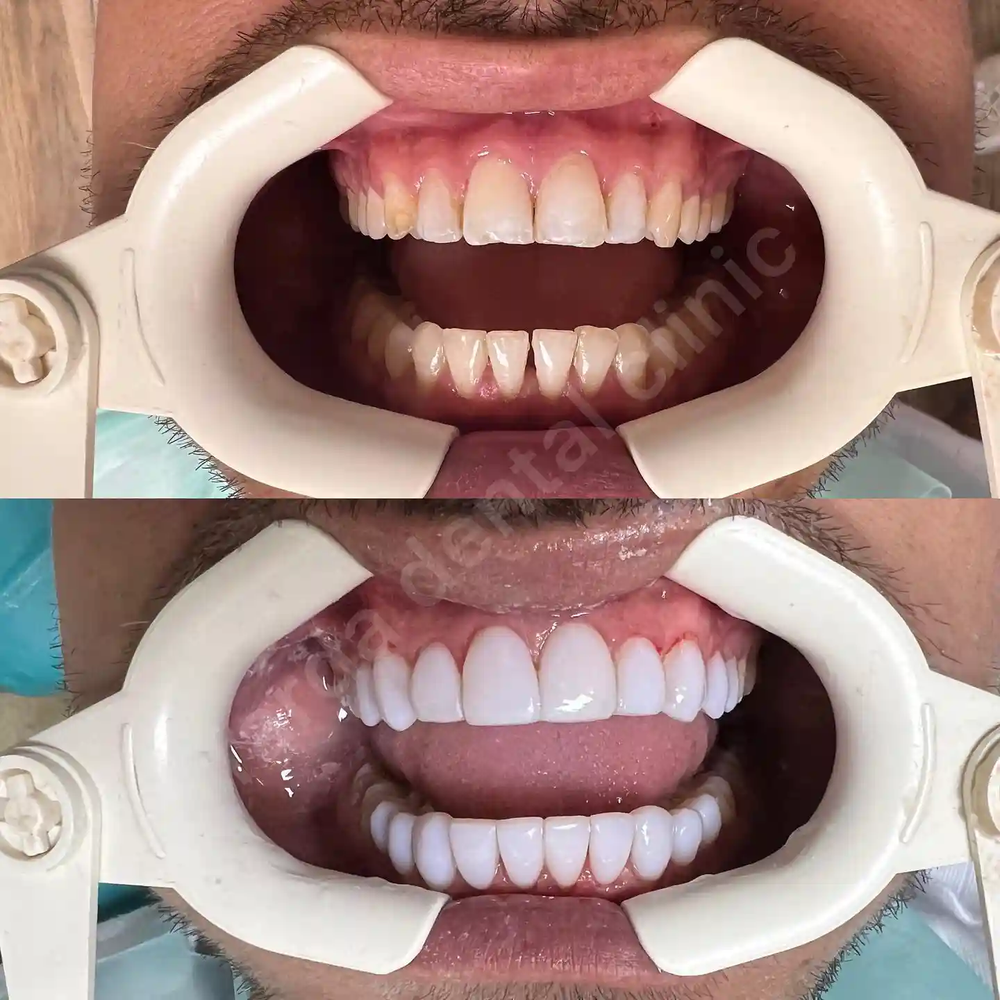 کامپوزیت دندان مشهد