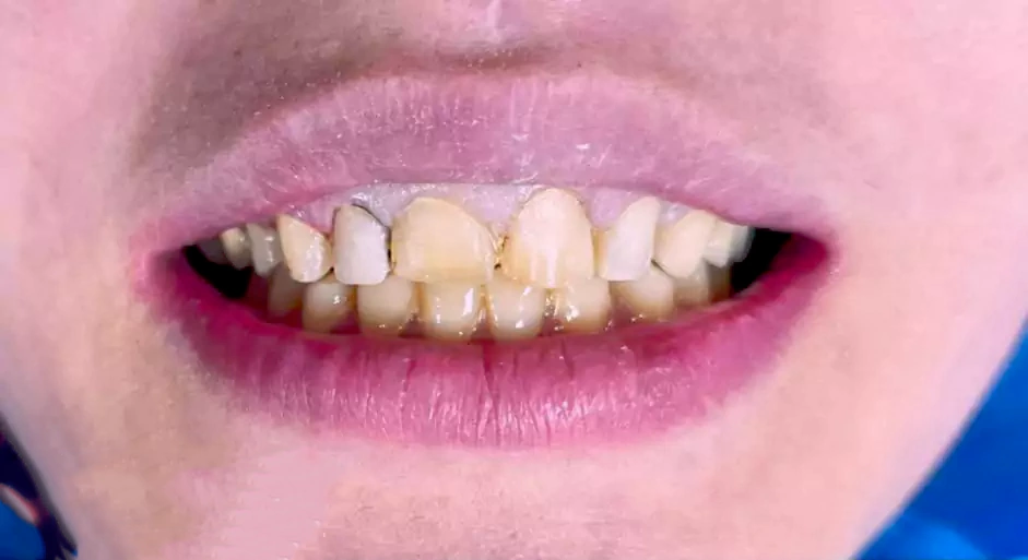 قبل ازروکش پرسلن