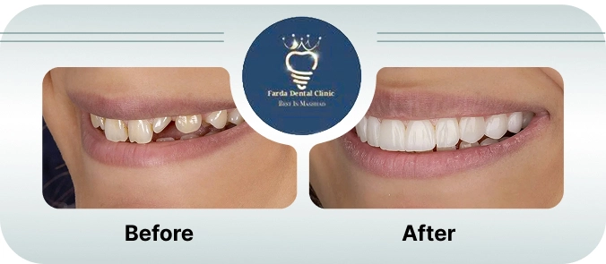 قبل و بعد از انجام لمینت