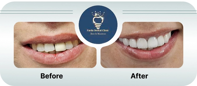 قبل و بعد لمینت دندان ها