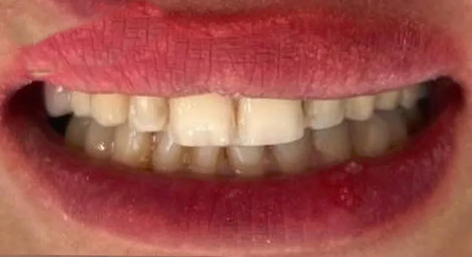 قبل از انجام لمینت پرسلن