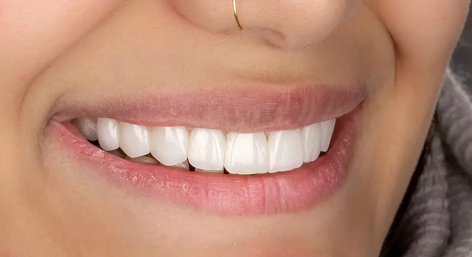 بعد از روکش E Max تمام پرسلن برای دندانهای لترال