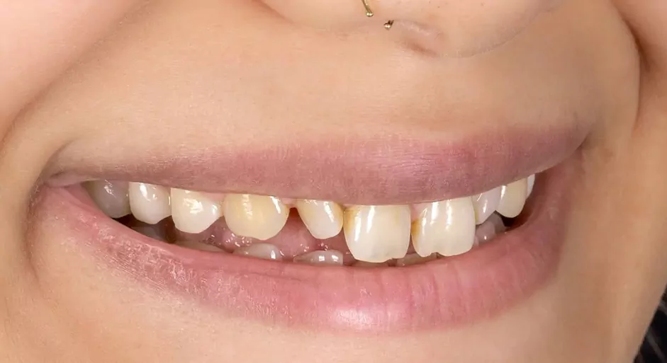 قبل از لمینیت پرسلن دندان‌های قدامی و روکش E Max تمام پرسلن برای دندانهای لترال