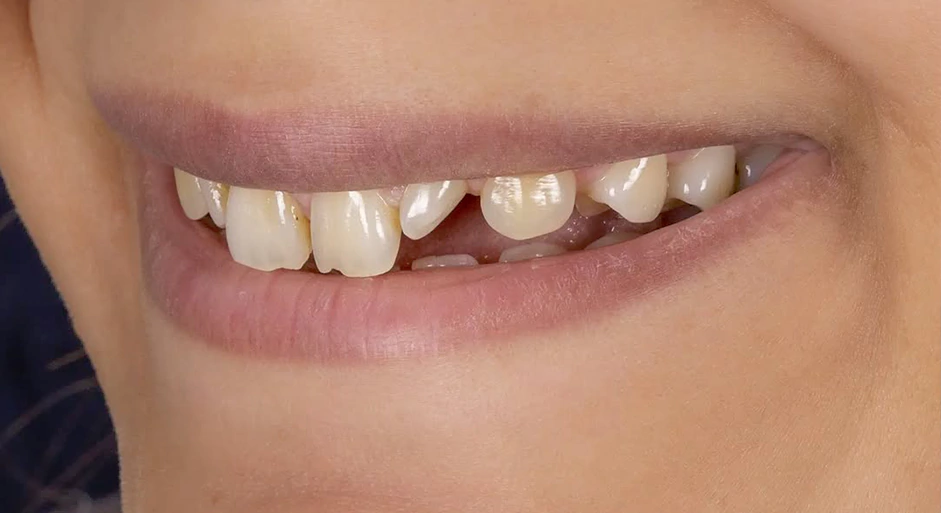 قبل از انجام لمینیت پرسلن دندان‌های قدامی و روکش E Max تمام پرسلن برای دندانهای لترال