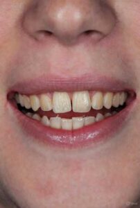 لمینت دندان خرگوشی1